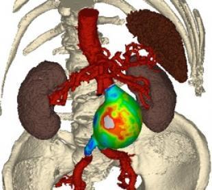 Visualisation of wall stress in a large patient specific abdominal aortic aneurysm - Dr Noel Conlisk